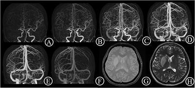 Collateral Vessels on 4D CTA as a Predictor of Hemorrhage Transformation After Endovascular Treatments in Patients With Acute Ischemic Stroke: A Single-Center Study